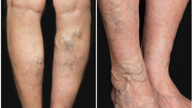 Researchers at the Stanford University School of Medicine have found a connection between height and varicose veins.