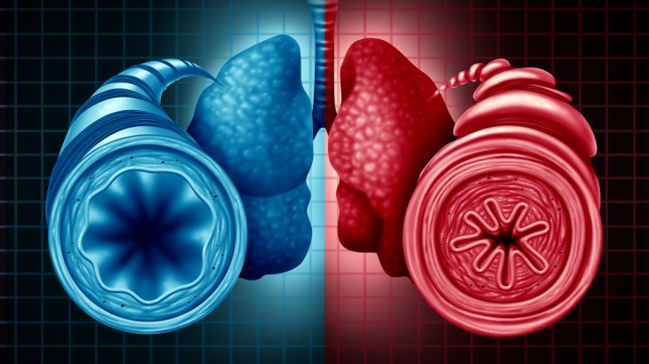 Obesity may be the cause of about a quarter (23 to 27%) of asthma cases in children who struggle to maintain healthy weight.