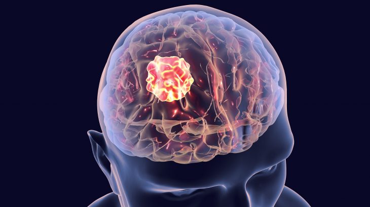 Researchers have identified distinct molecular signatures in cancers like the deadly brain tumor glioblastoma in male and female patients.
