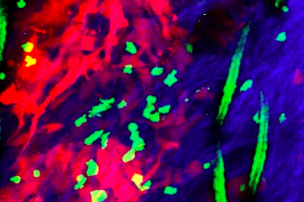 Researchers may have discovered a revolutionary new method for treating skin cancer by using immune cells that put tumors "to sleep."
