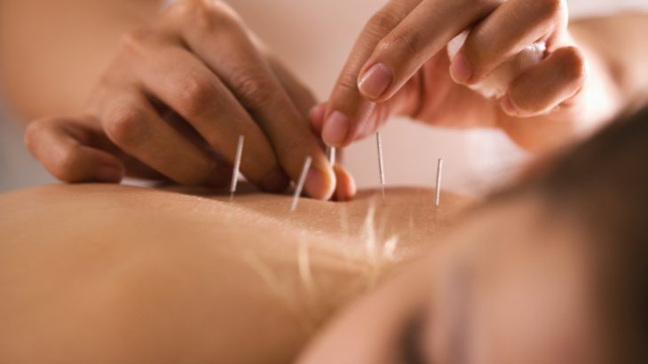 Several weeks of acupuncture can help alleviate hot flashes and other disruptive symptoms commonly associated with menopause, according to a new study.