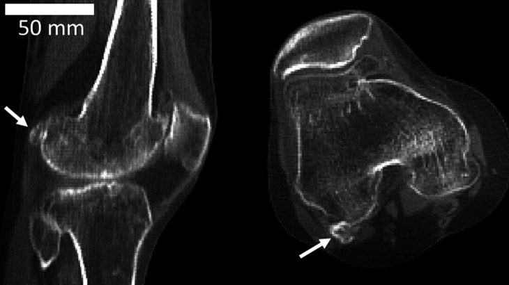 An extra knee bone called the fabella is appearing more and more often in modern humans, and diet may be the cause. (Photo credit: Imperial College London)