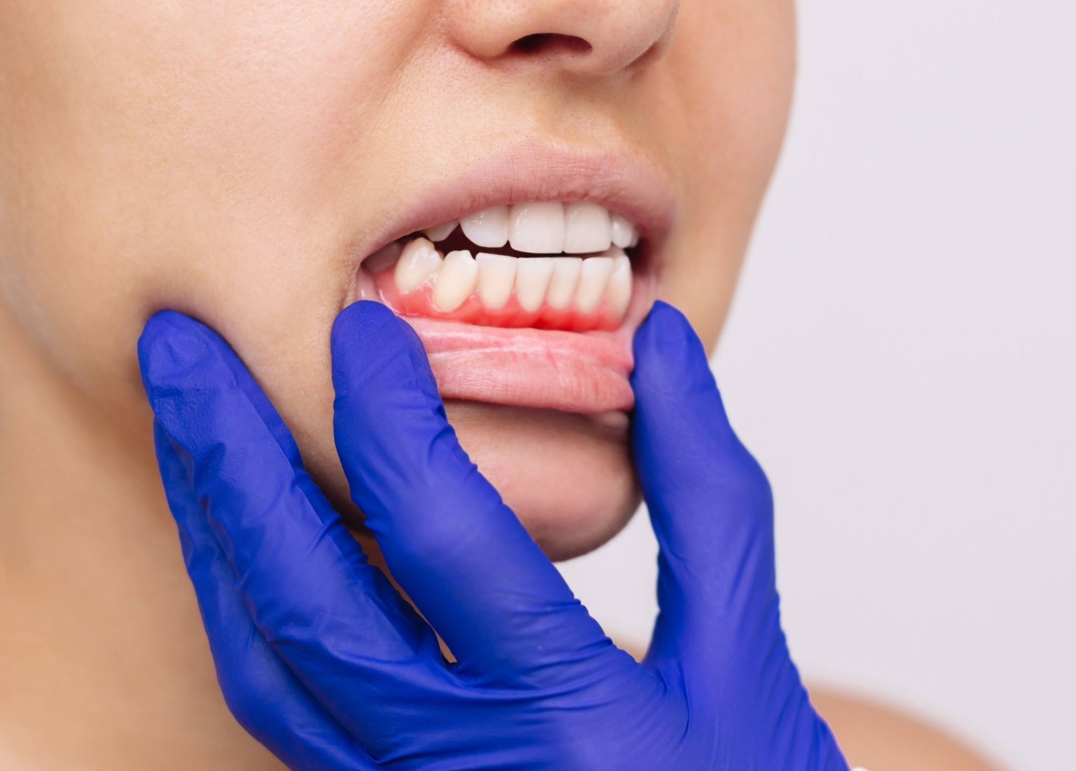 Plaque in orbit: Gum disease gets worse in space