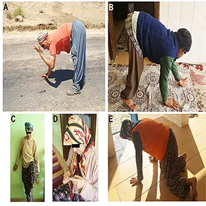 A: He has quadrupedal gait pattern and he can walk around in the village (Case 3) (in 2008). B: He has quadrupedal gait pattern (Case 3) (in 2018). C-D: She can sustain one leg standing with minimal assistance, and she can do handicrafts (Case 4) (in 2008). E: She has quadrupedal gait (Case 4) (in 2018). Credit: Springer Nature
