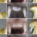 The end of dentures: Science is about to let you chew again with your own teeth