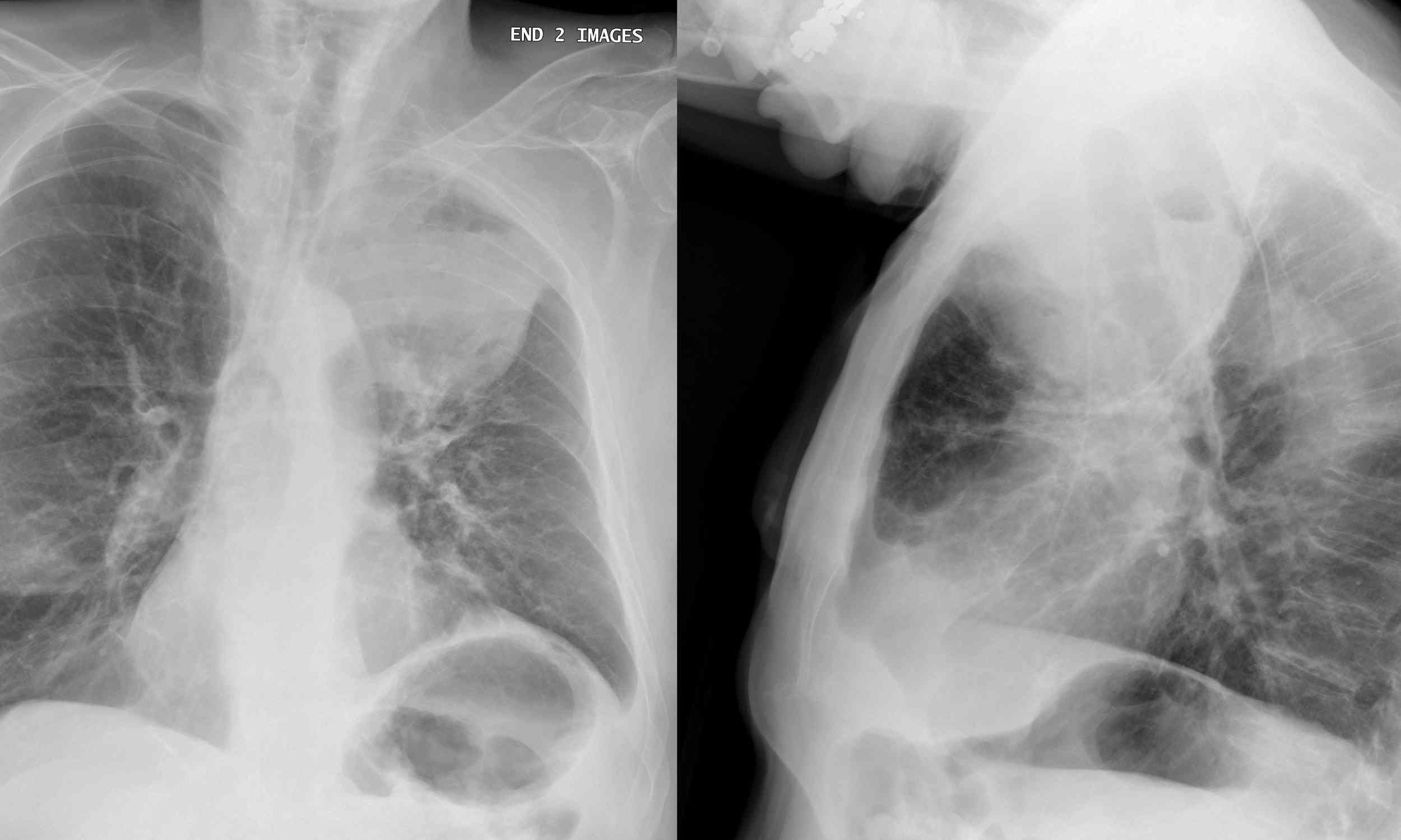 Unbelievable Cancer Breakthrough: Bacteria That Shrink Tumors Without Immune Help!