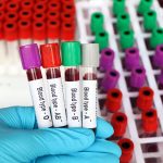 Scientists discover a surprising link between blood type and stroke risk