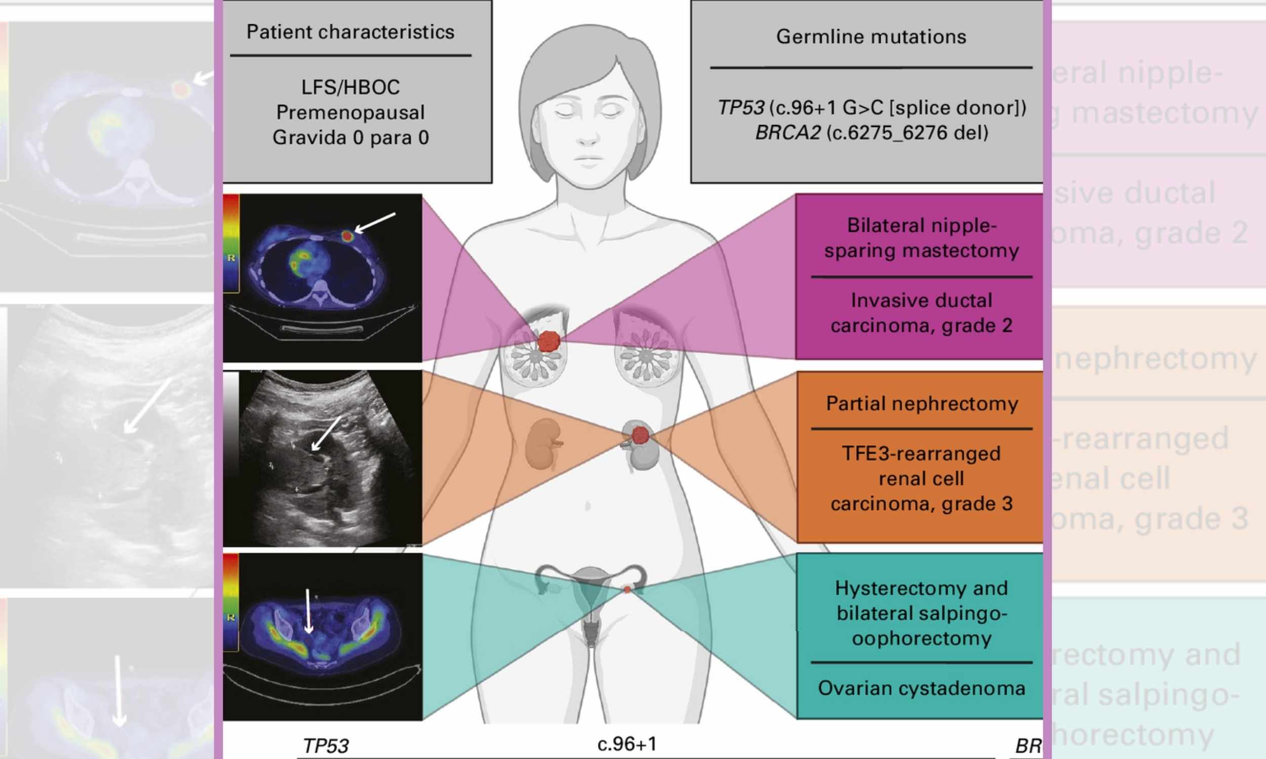 Early symptoms of ovarian cancer mimic simple weight gain - Earth.com