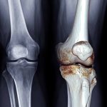 Science confirms that the best treatments for knee osteoarthritis are not medications
