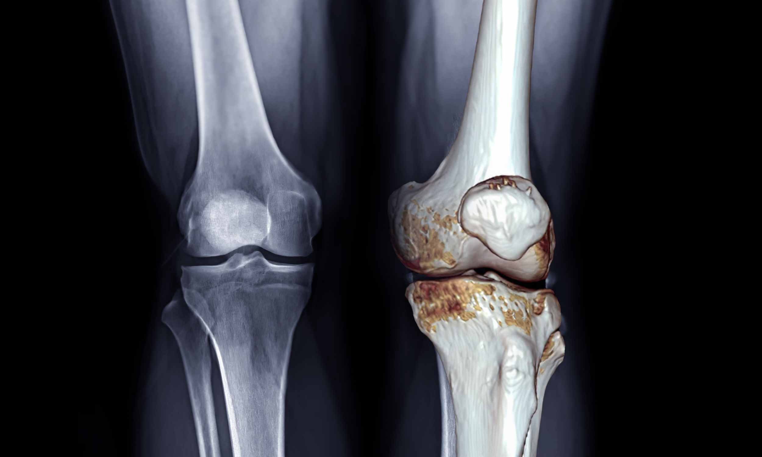Scientists confirm the best treatments for osteoarthritis are not medications
