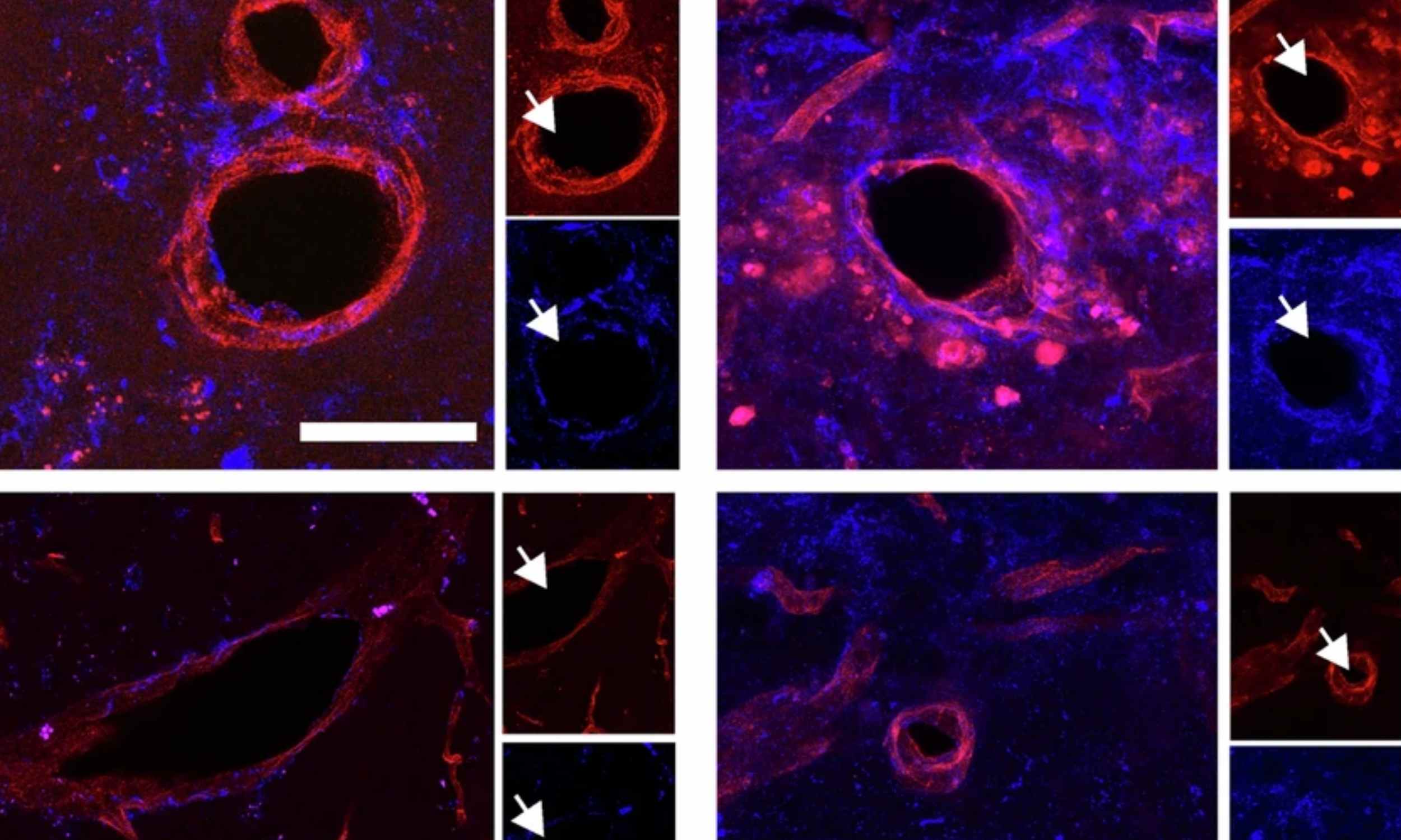 Stem cell transplant trial restores movement in stroke victims