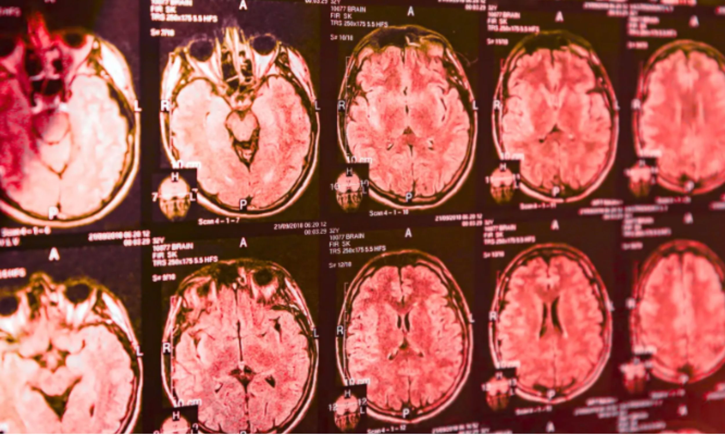 Blood test could detect Parkinson's before tremors appear