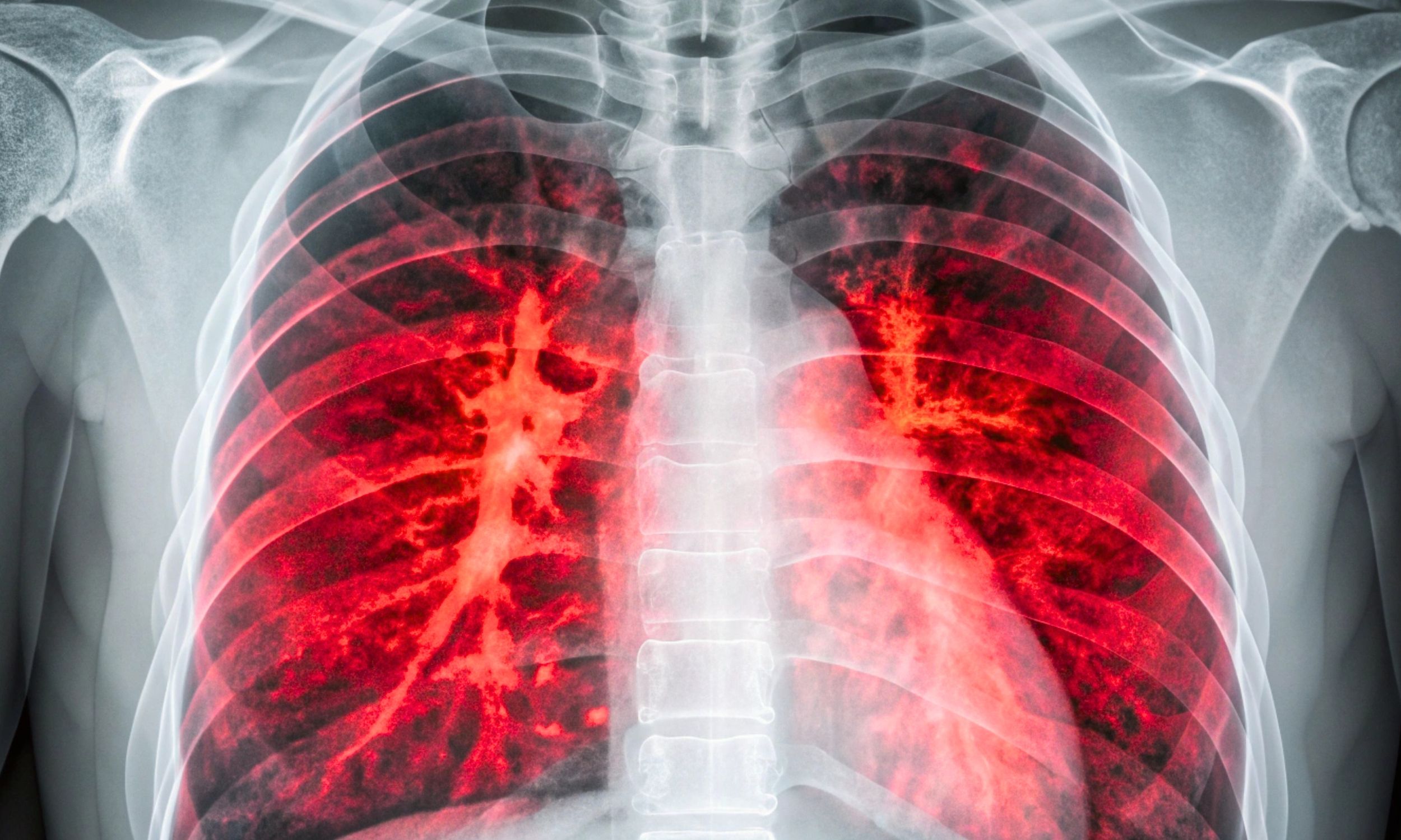 Fecal metabolite could change the course of lung cancer treatment