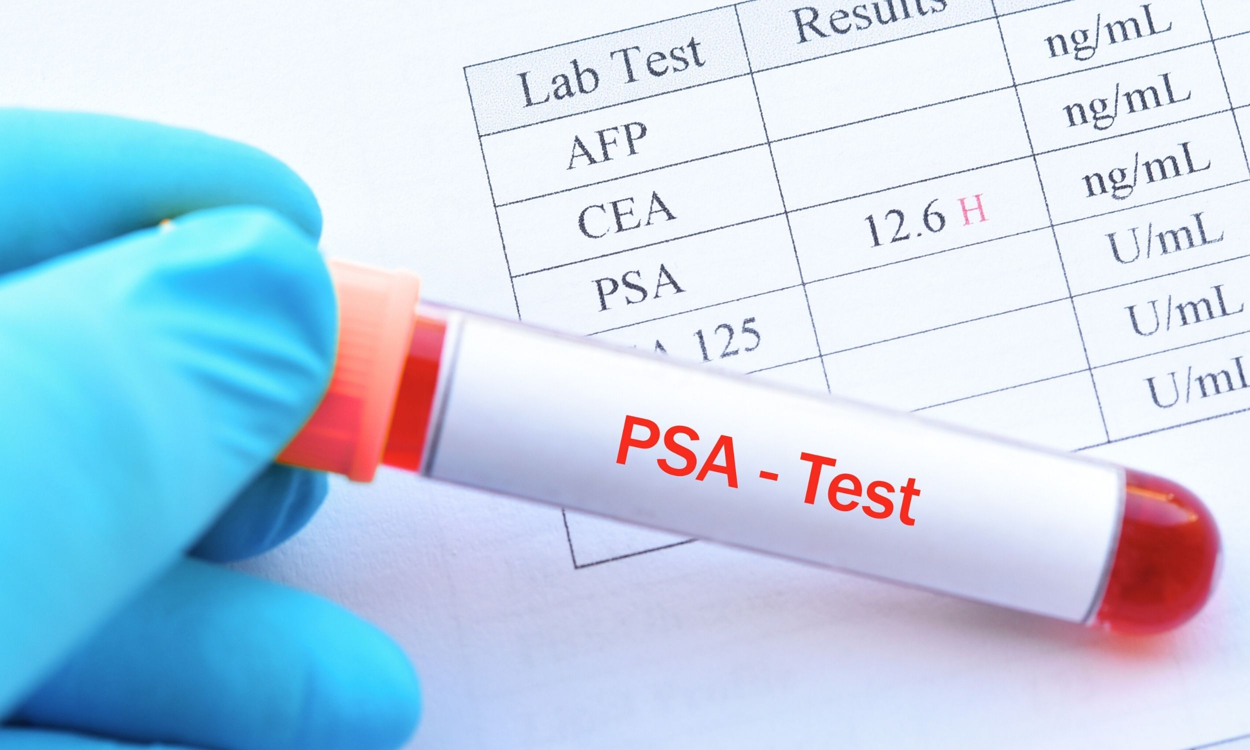 Doctors find a fairly simple way to control PSA levels and prostate cancer
