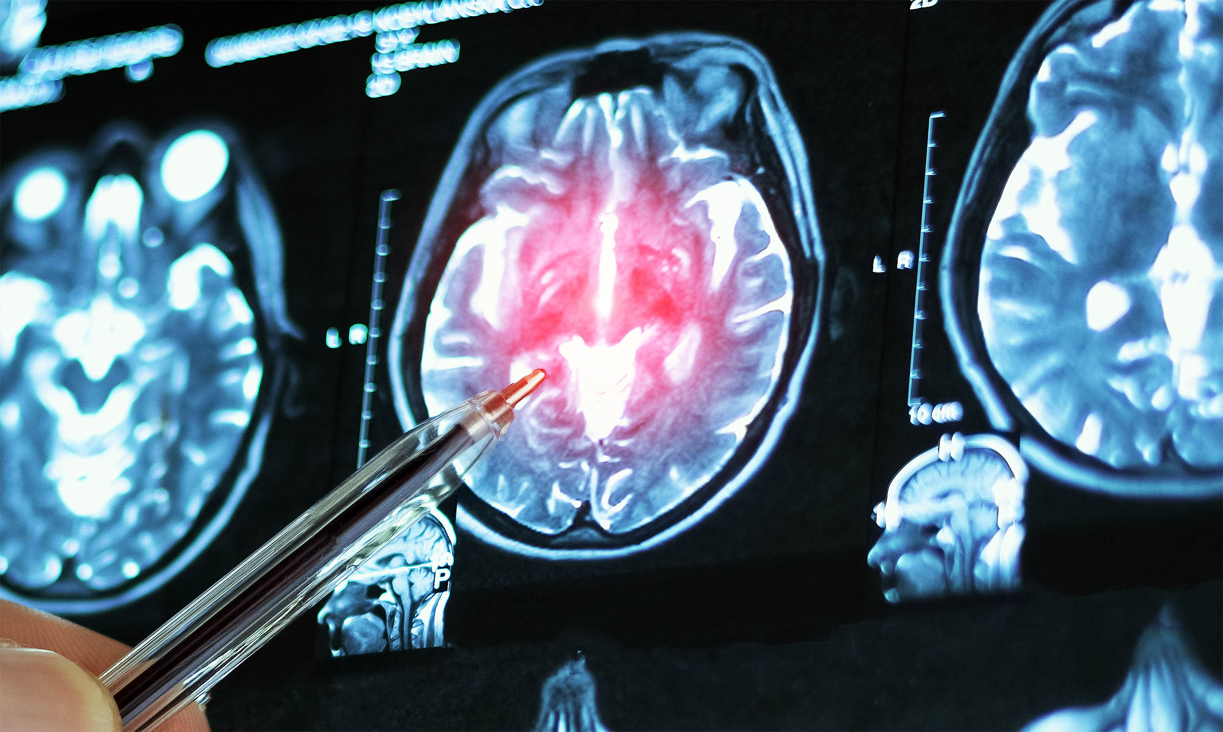 Experimental drug restores memory loss caused by Alzheimer's disease, defying decades of research