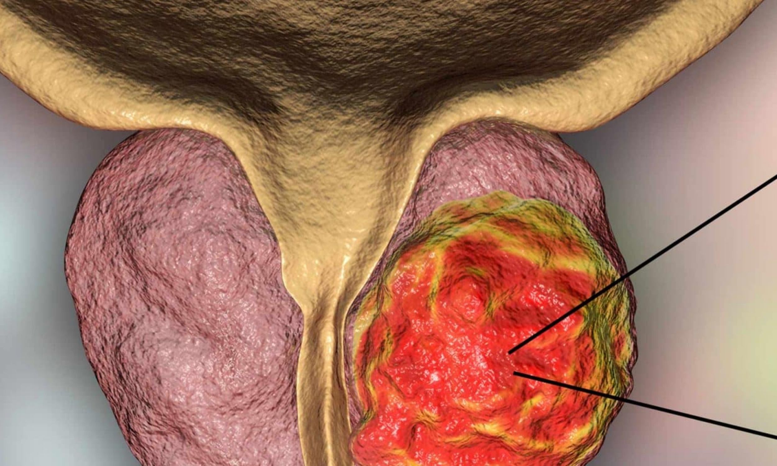 Frequent ejaculation is associated with lower risk of prostate cancer