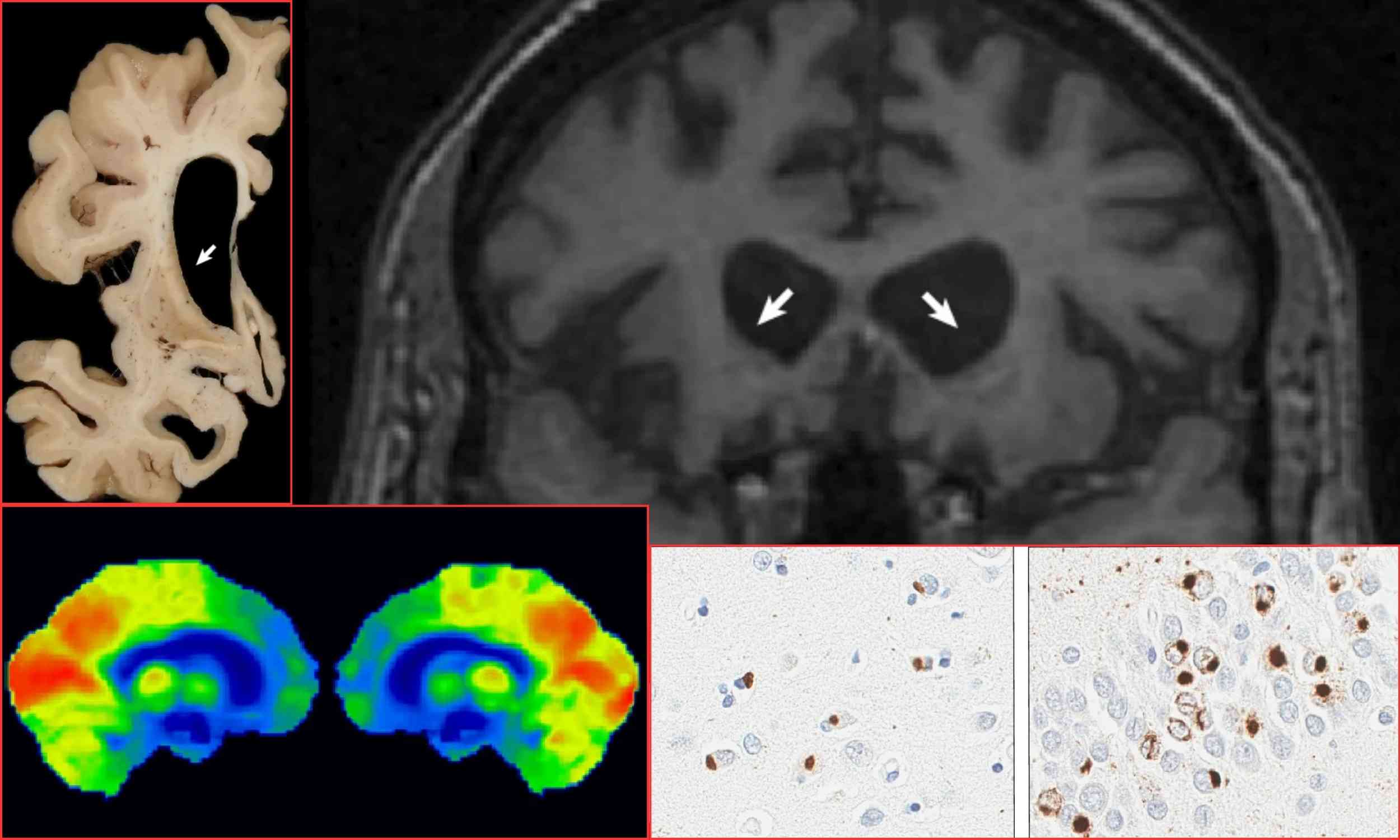 Rare dementia tied to DNA repeat on chromosome 15