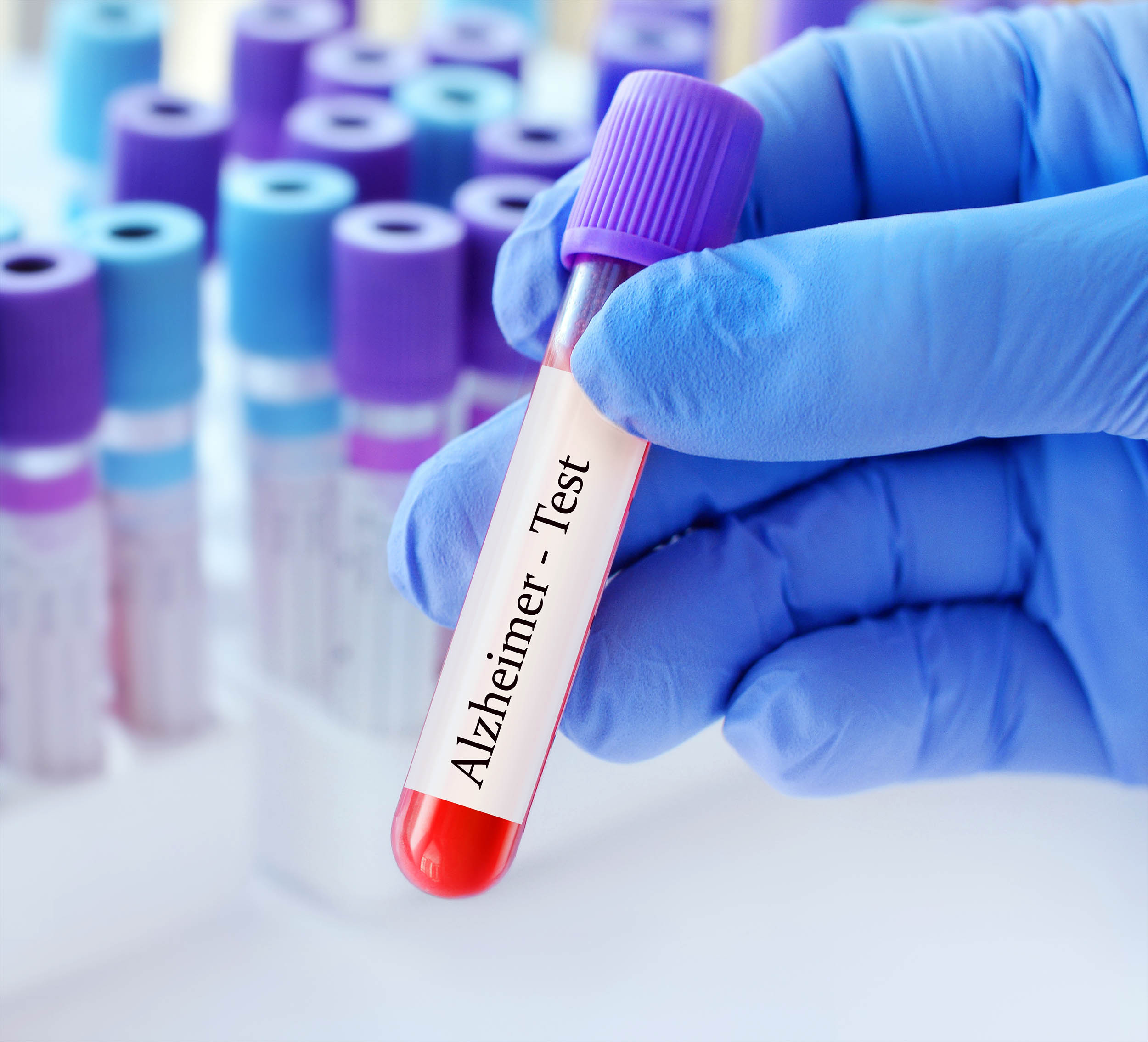 Scientists create blood test that predicts dementia 25 years before symptoms appear