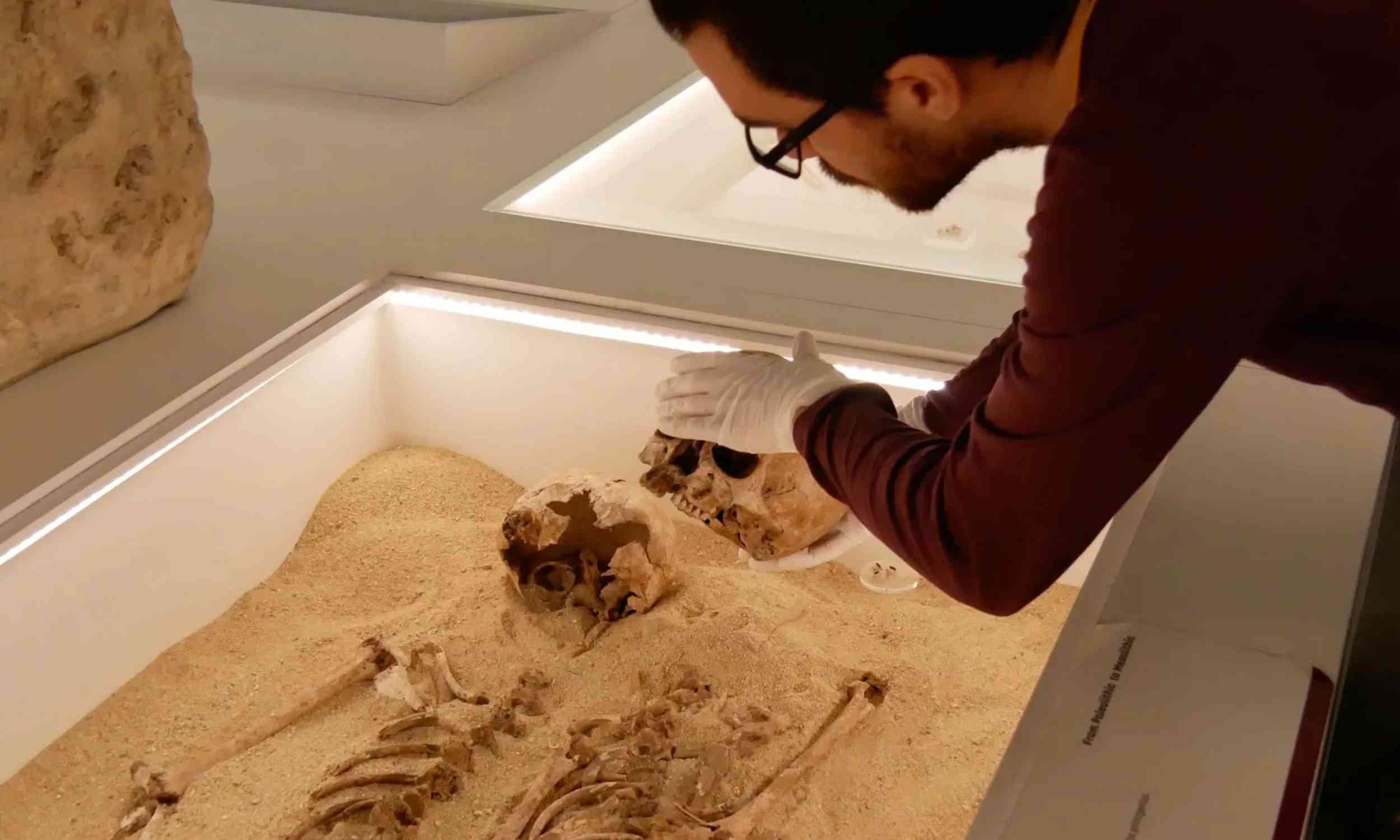 Ice Age girl reveals earliest known genetic disorder