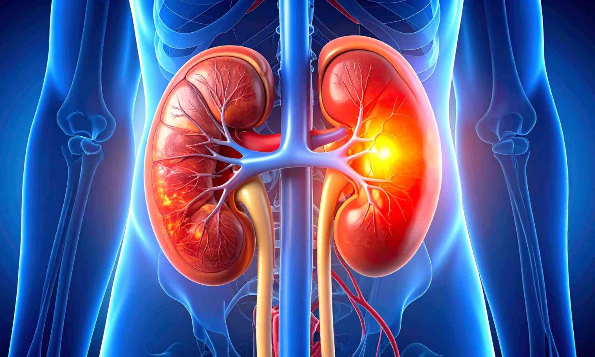 Drinking more water is often not enough to stop kidney stones from returning