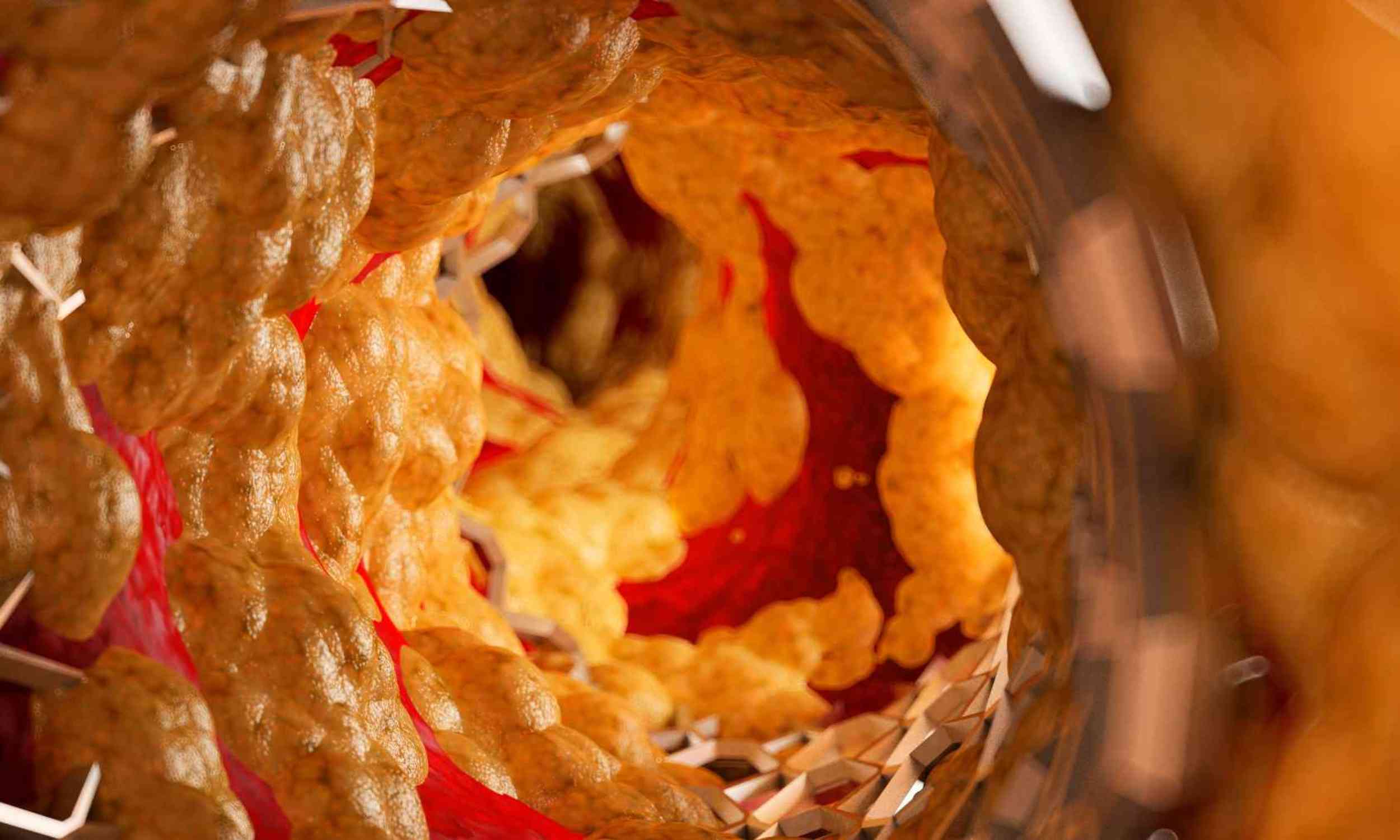 DNA treatment lowered bad cholesterol by nearly half without using statins