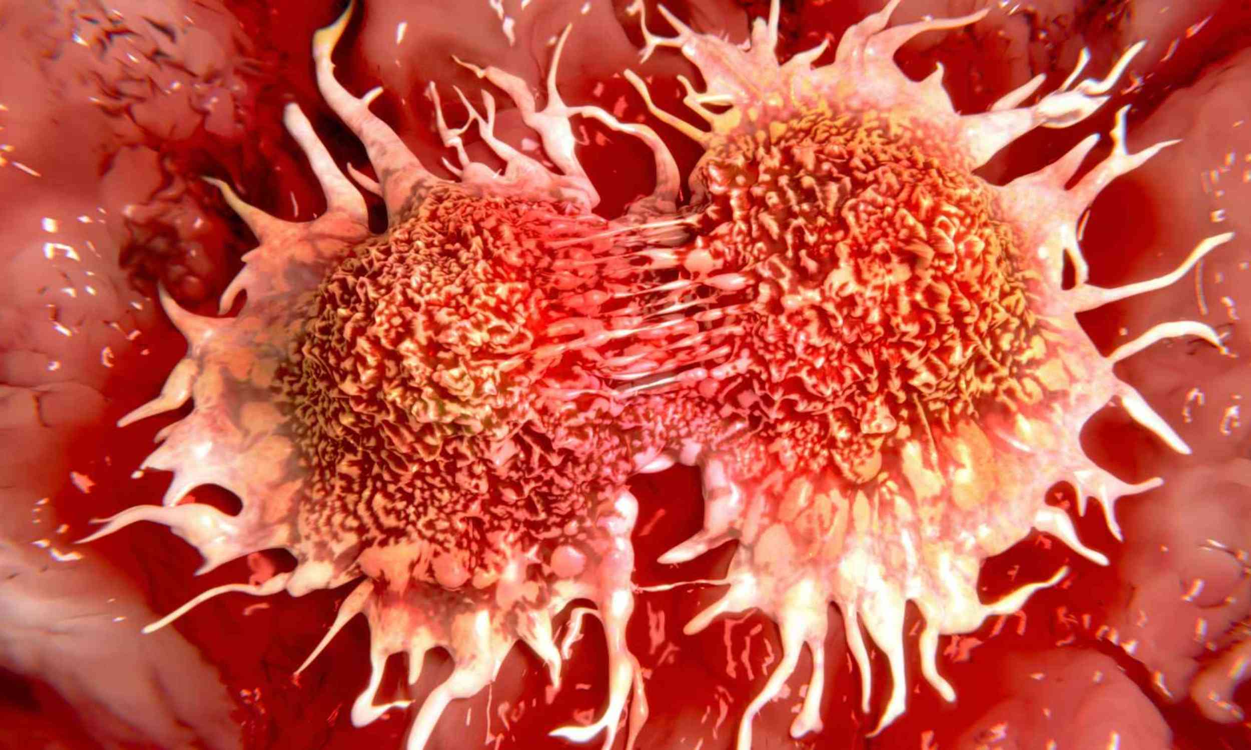 Cancer is rising worldwide, but millions of cases may go undiagnosed