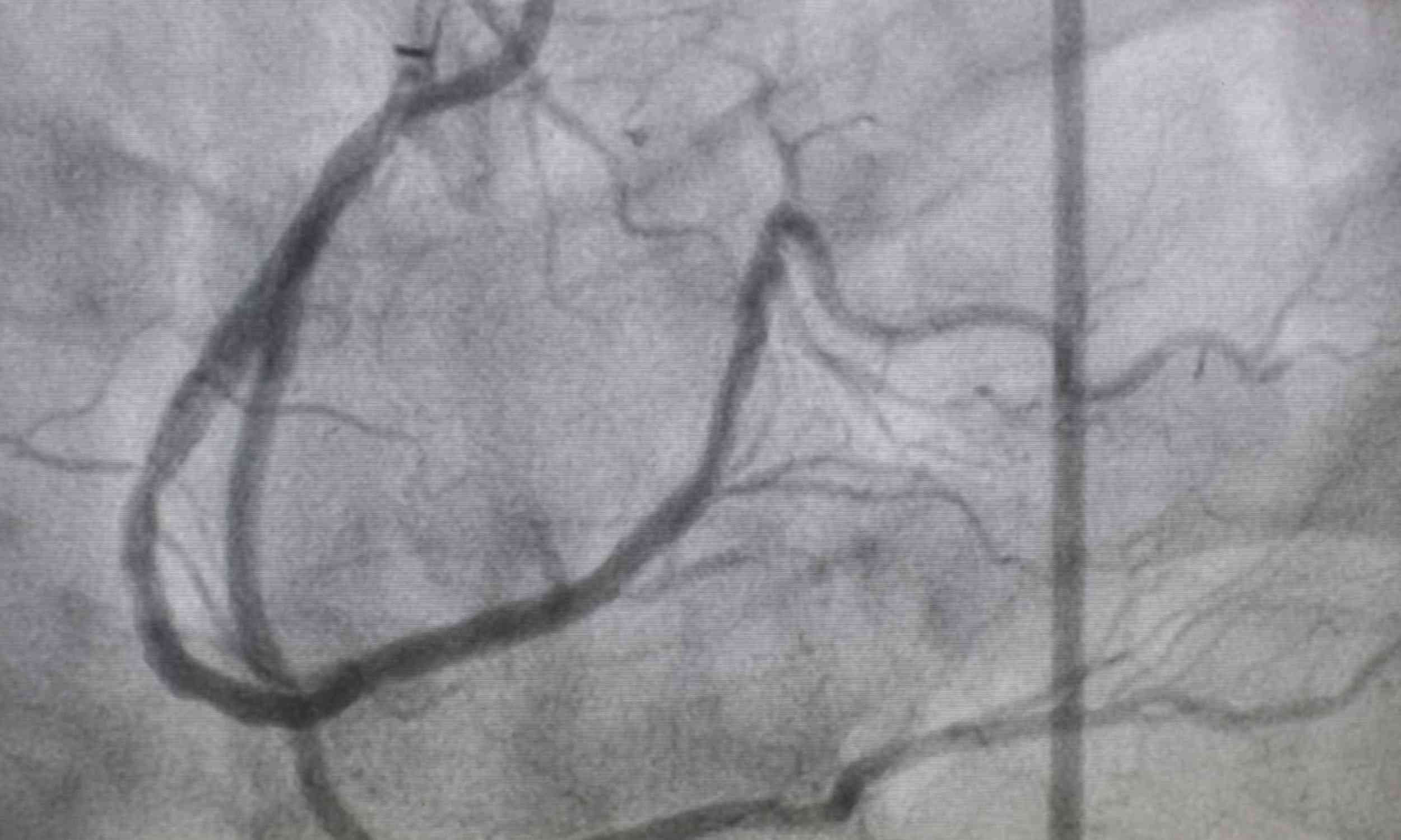 New stroke trial reveals why reopening a blocked artery is sometimes not enough