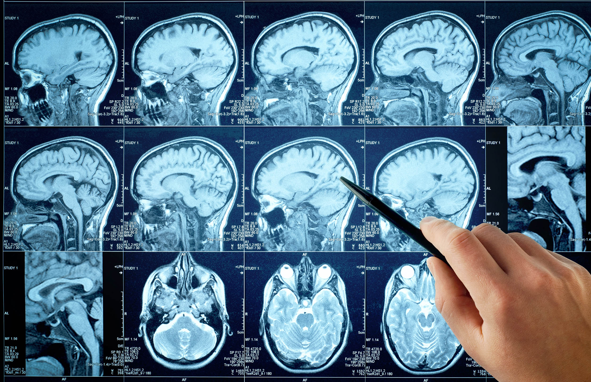 Duration and severity of depression symptoms directly influence changes in brain function
