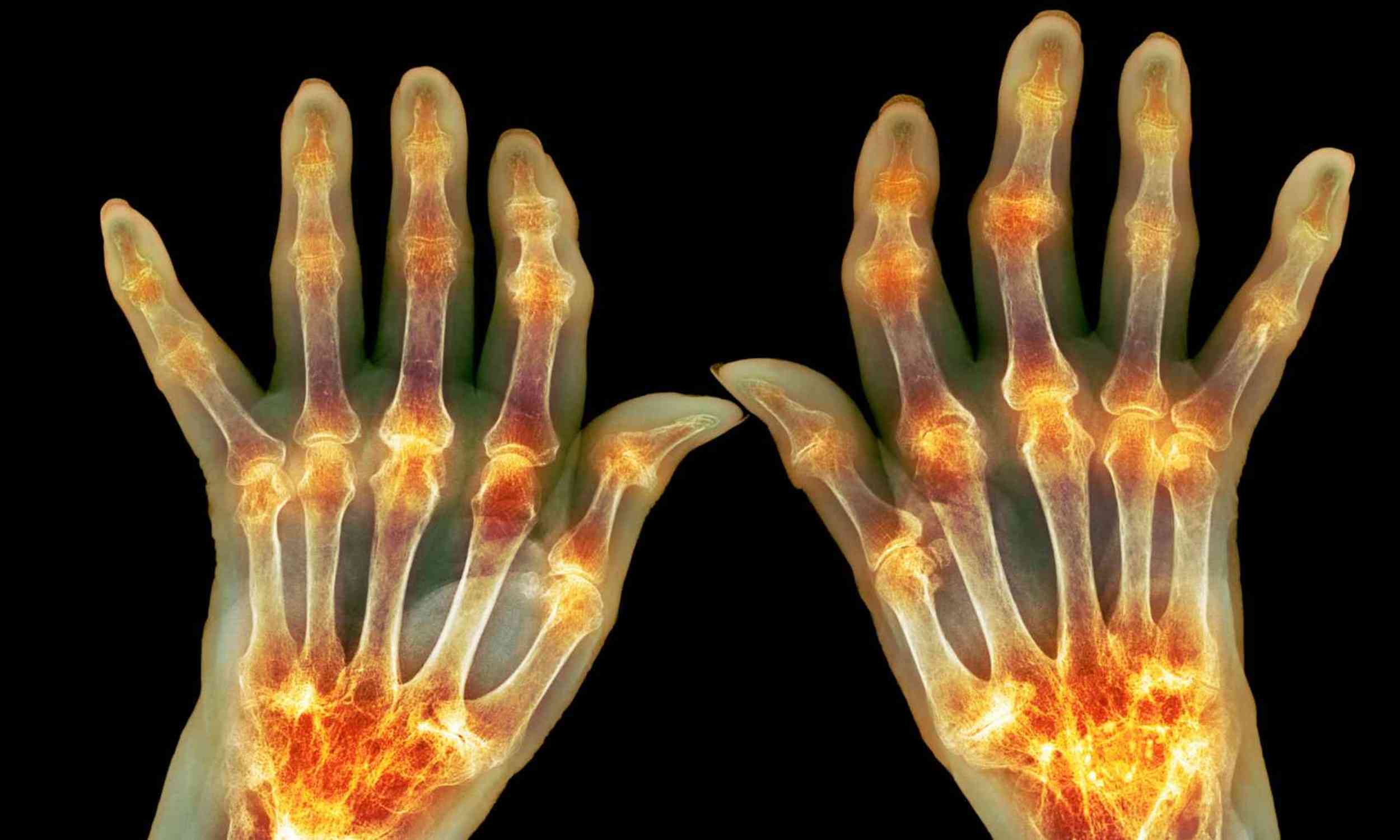 glp 1 joint inflammation Weight-loss drugs may unexpectedly relieve inflammation in painful joints