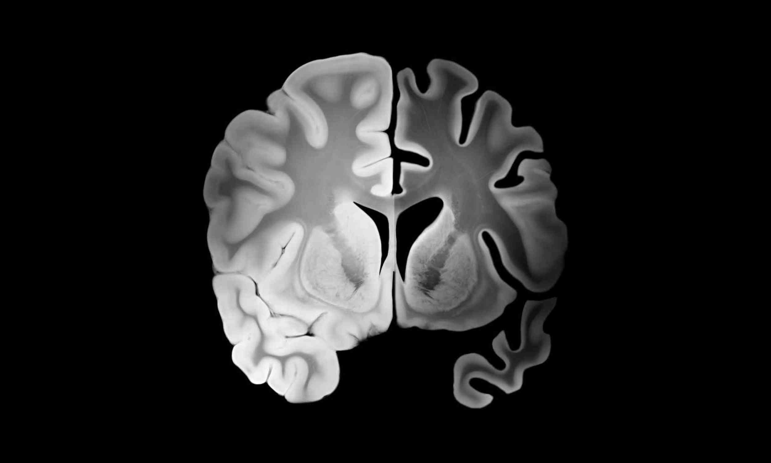 Scientists have found new clues that lithium does something strange inside Alzheimer’s cells