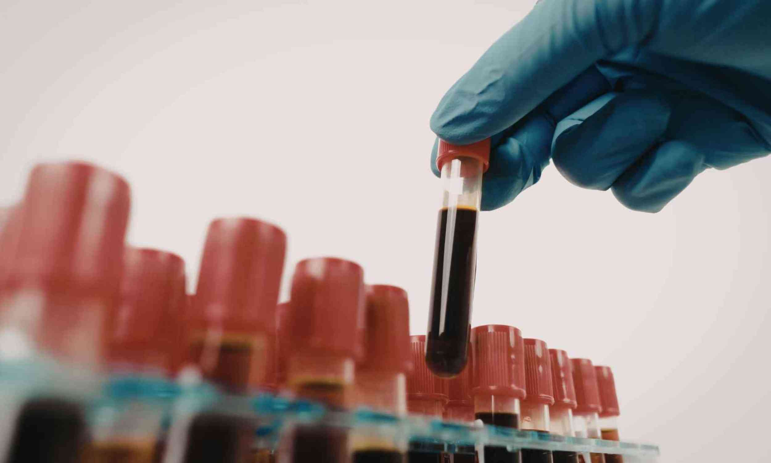 A blood test may reveal hidden brain injuries in older adults after a fall
