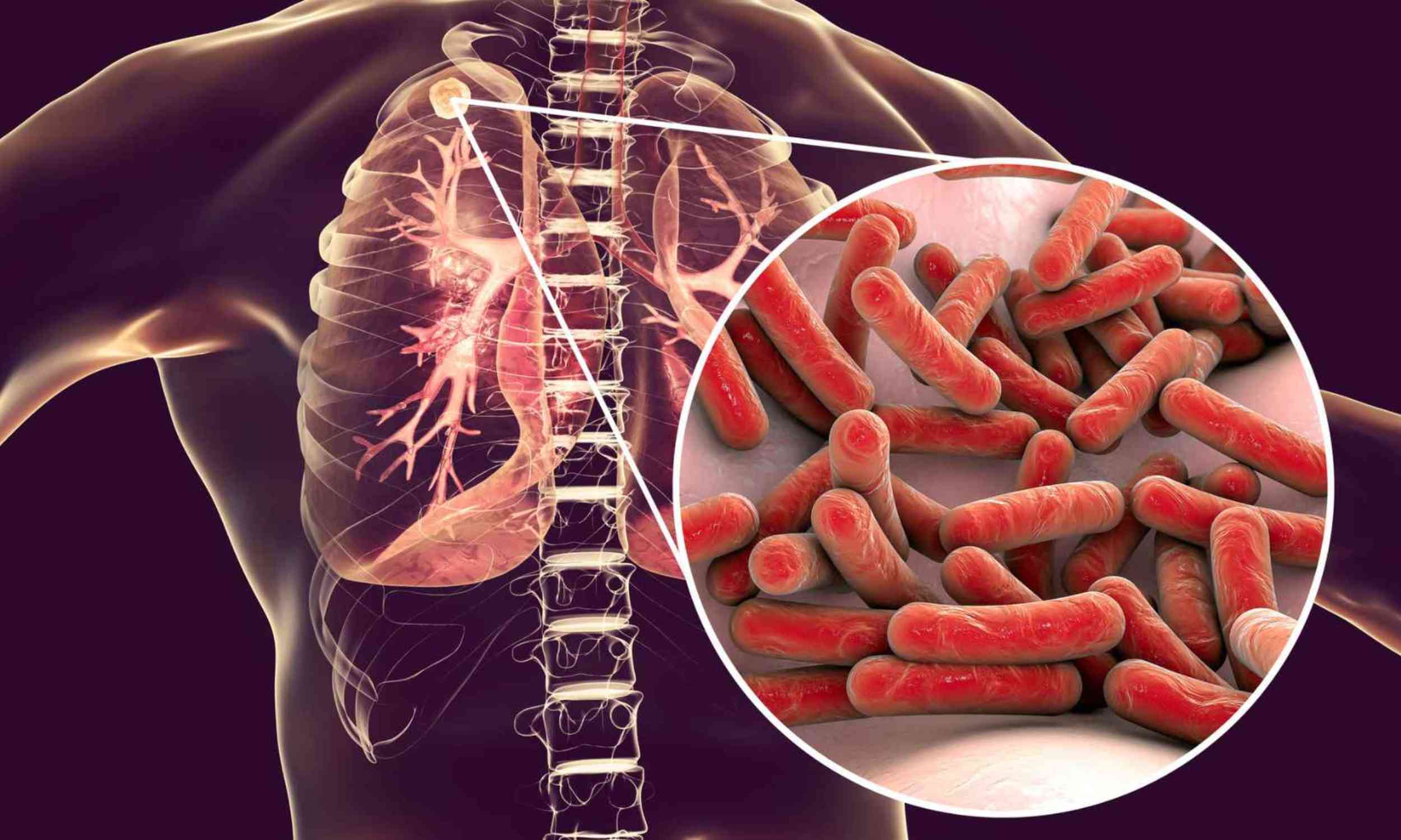 Tuberculosis may spread before people realize they are sick, a new study warns