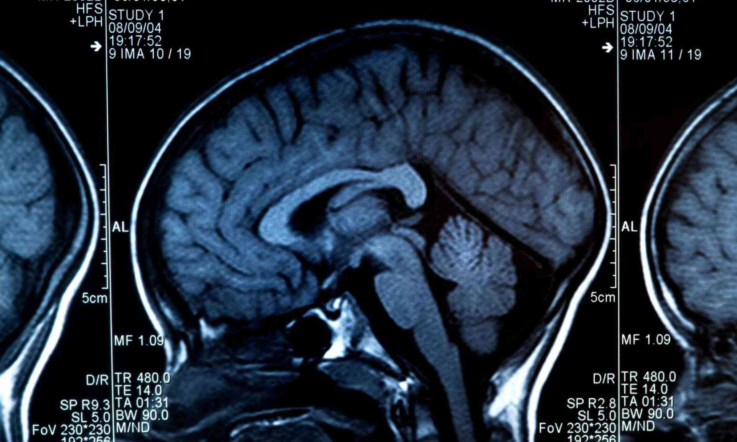 Common flu drug may also protect the brain in a way doctors never expected