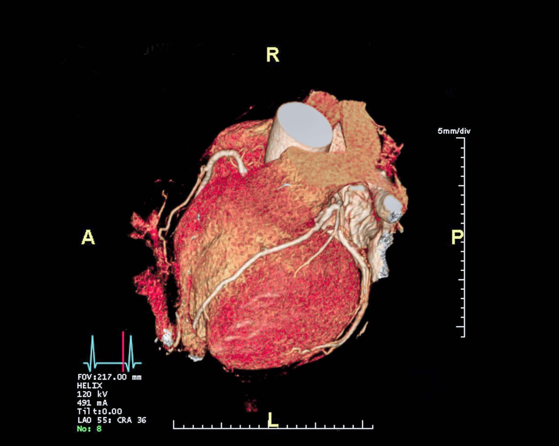 Heart scans may predict cancer risk years before diagnosis