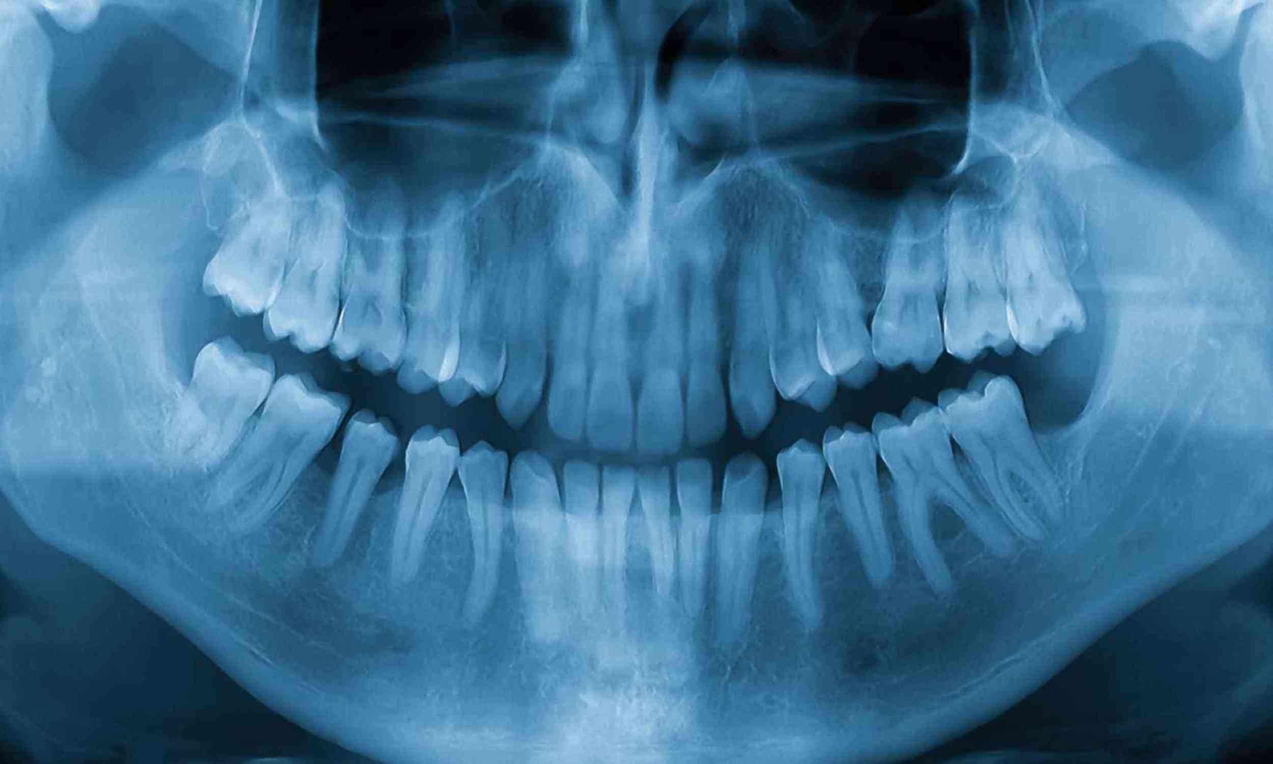 New drug may unlock the body’s ability to grow new teeth