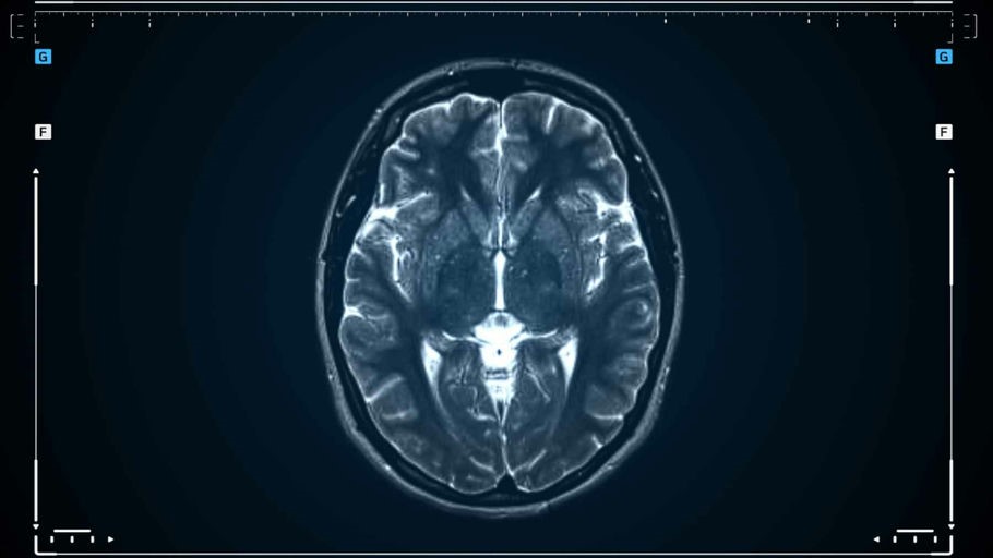 Brief confusion after surgery may be a warning sign for future brain decline