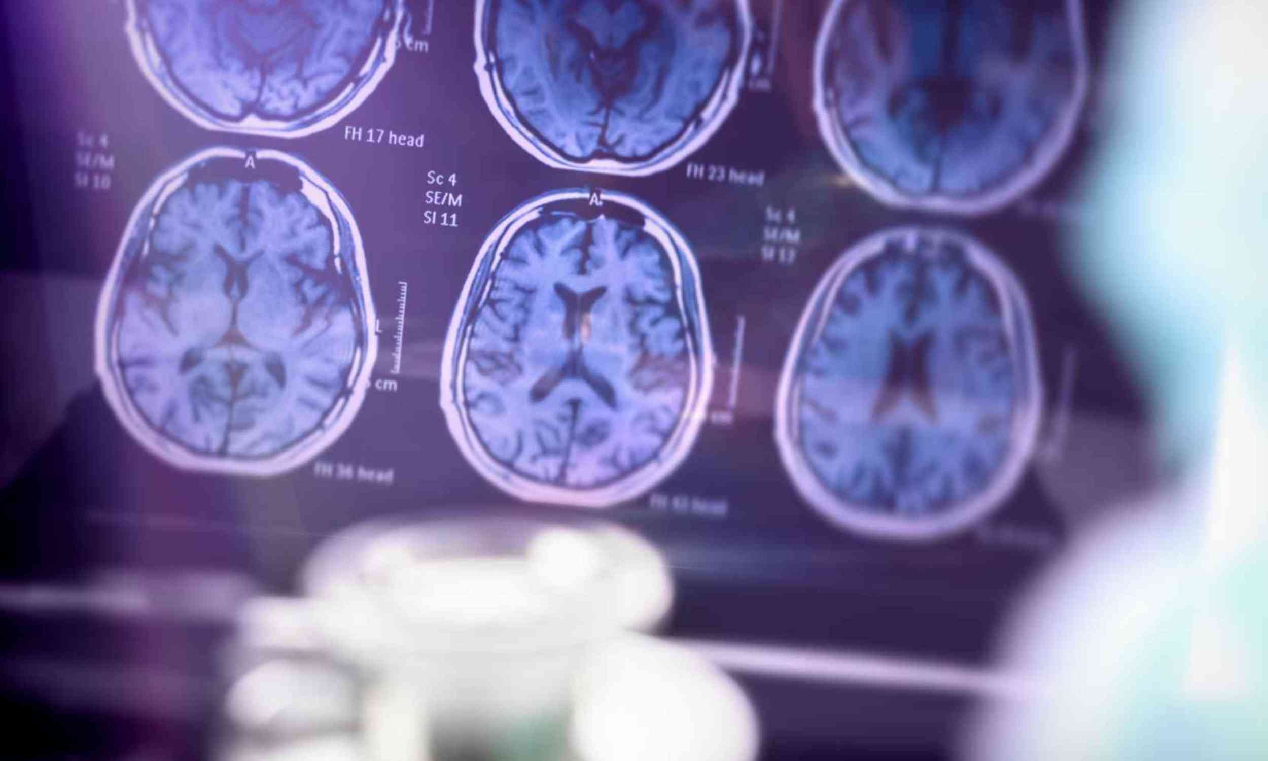 Scientists found a protein trap in Alzheimer’s brains, and a new compound may break the cycle