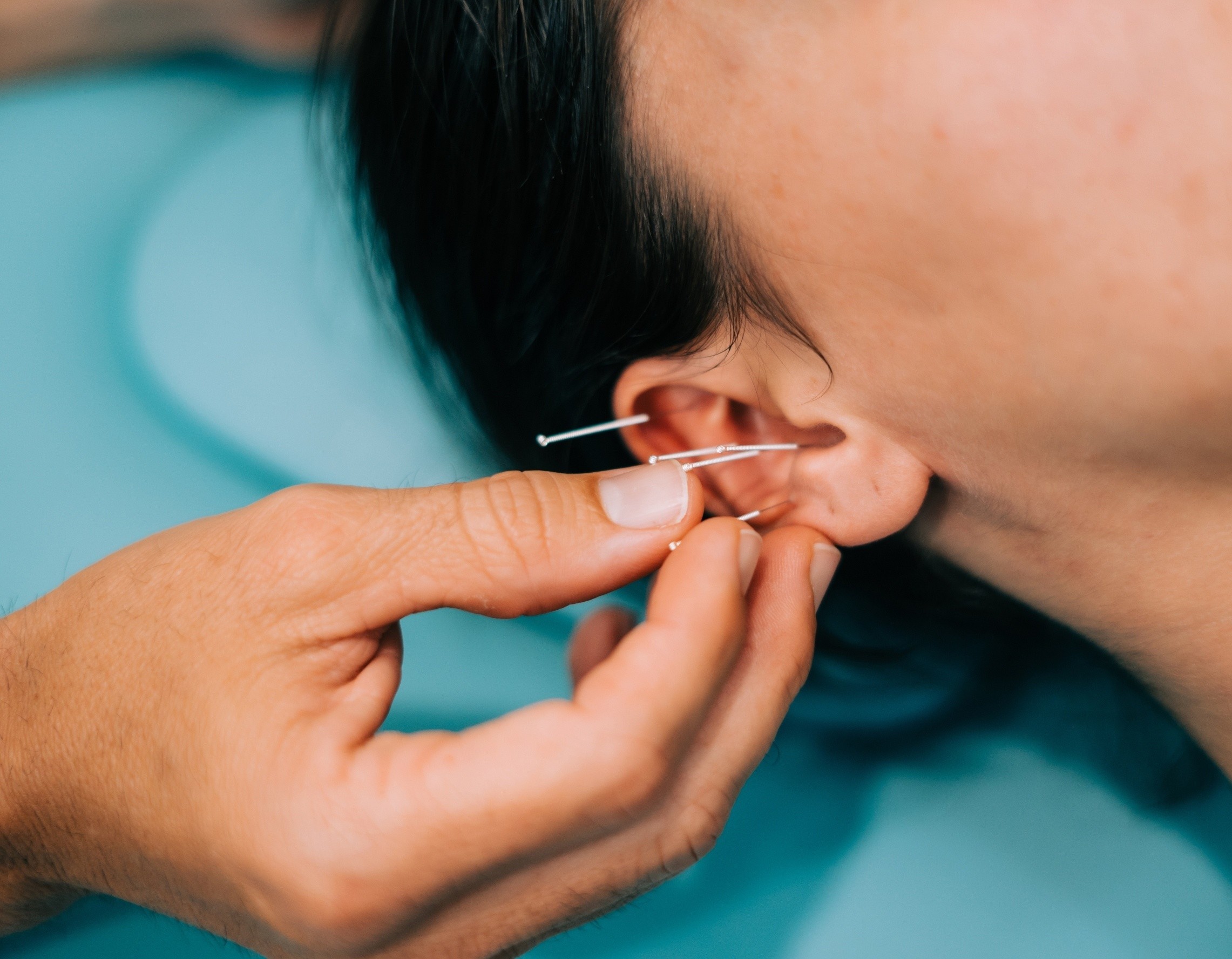 Ear acupuncture shows promise for chronic migraine relief