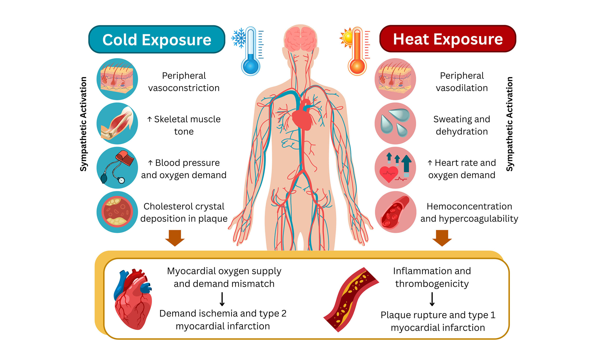 Extreme heat and cold can trigger heart attacks, strokes, and sudden cardiac death