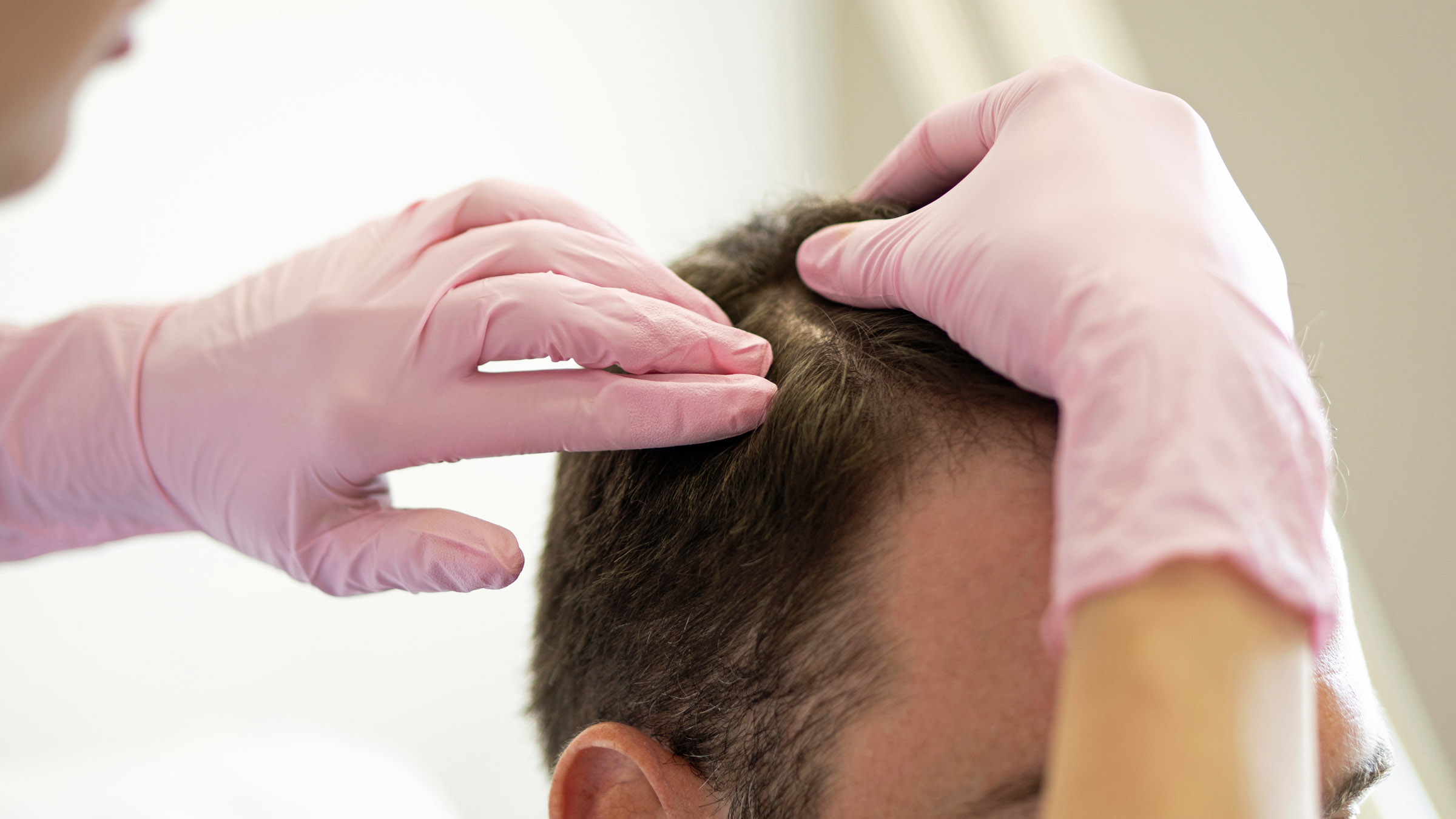 Deadly superbug Candida auris hides inside hair follicles, where the skin's own immune system helps it survive
